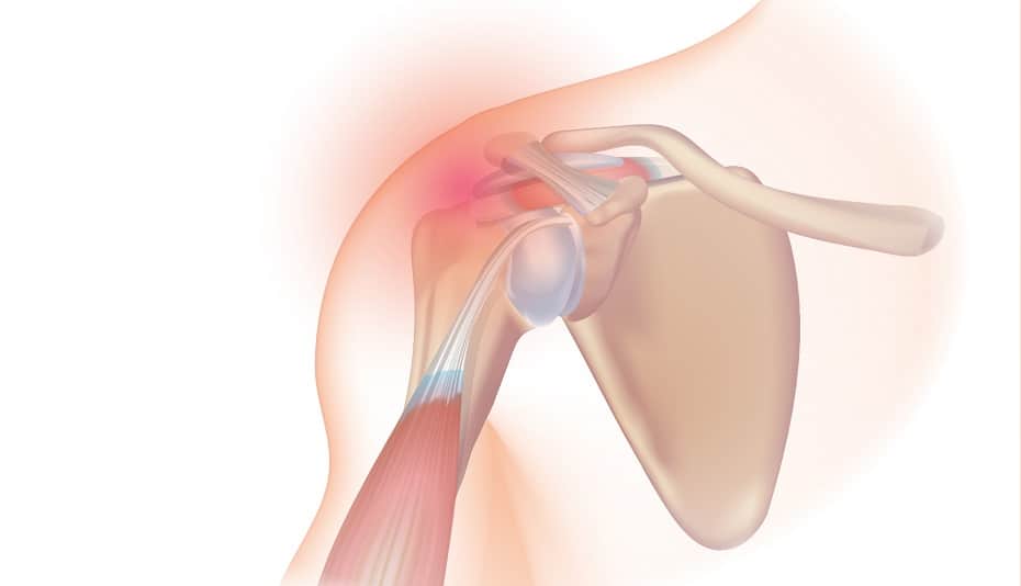 Rotor Cuff Injuries in golf