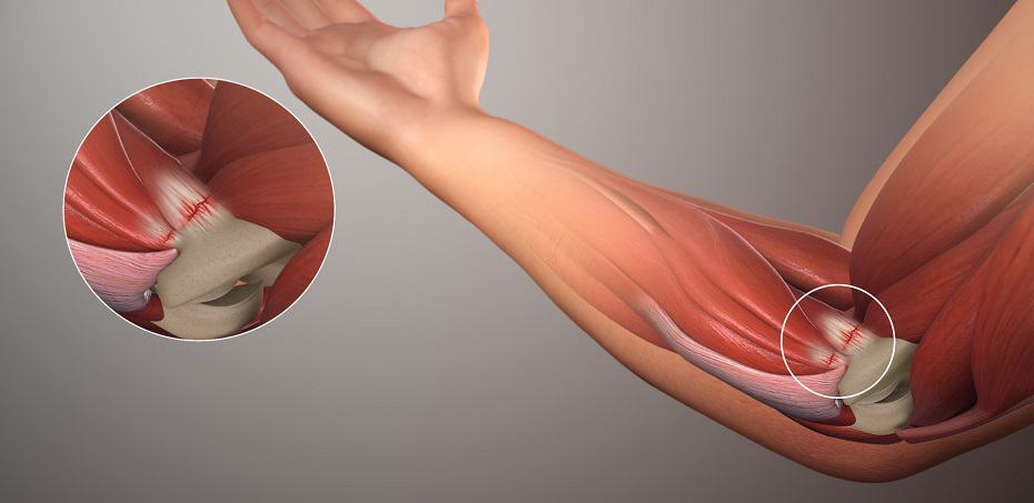 golfers elbow