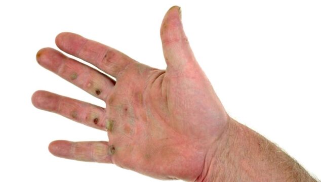 how to prevent blisters on hands from golf