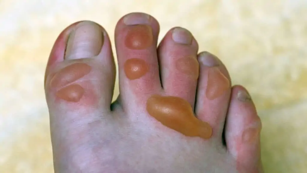 how to prevent golf blisters